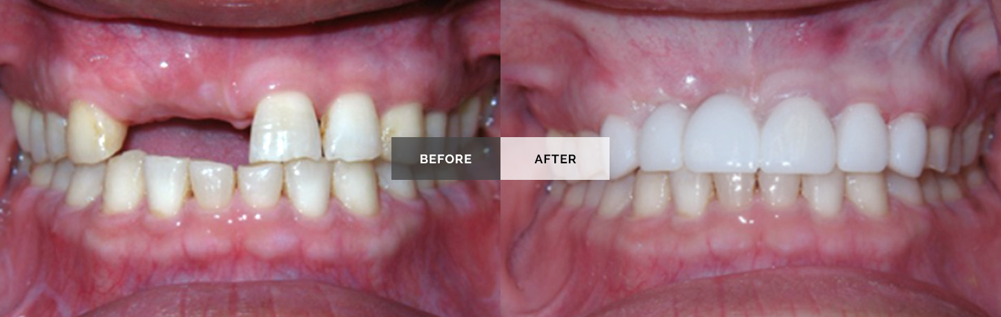 Dental Bridges For Front Teeth Dental Bridge Cost From 695 Mint Dental Bridges For Front Teeth Dental Bridge Cost From 695 Mint